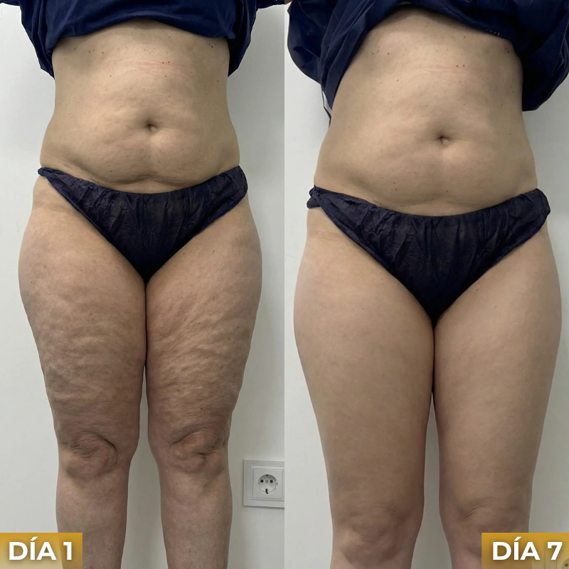 Veltrix™ Aceite Intensivo Anticelulitis Reafirmante